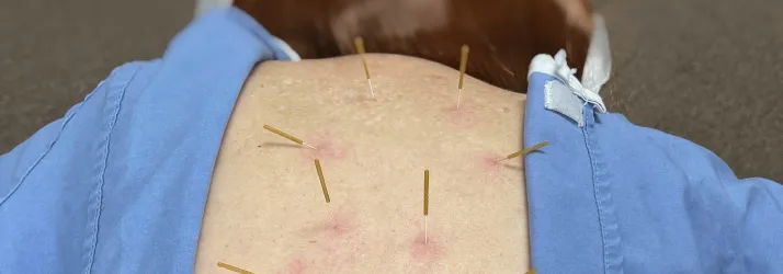 Chiropractic Plainview TX Dry Needling Back
